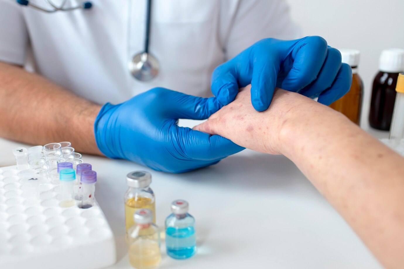 Monkeypox Outbreak Gains Momentum: Latest Developments in May 2024 - VizoCare
